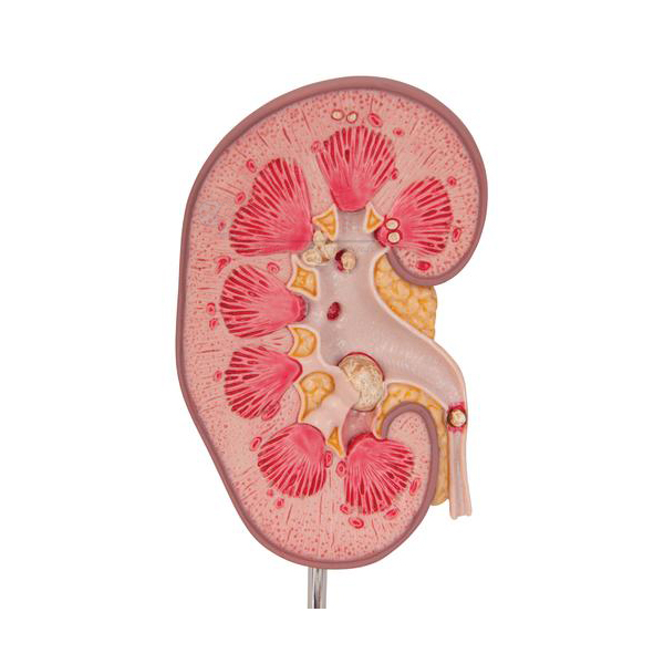Kidney Stone Model